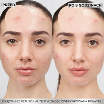 Garnier Pure Active plastry: przed i po 8h. Kobieta z trądzikiem, widoczna redukcja niedoskonałości.