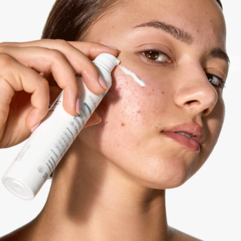 Kobieta aplikuje krem-żel przeciwtrądzikowy z białej tubki na policzek, redukując wypryski i sebum.