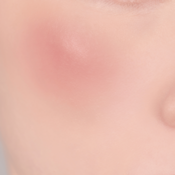 Bardzo bliskie ujęcie fragmentu jasnej skóry, na której widoczny jest czerwony, lekko spuchnięty pryszcz lub stan zapalny.