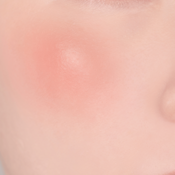 Zbliżenie na skórę z pojedynczą, czerwoną i wypukłą zmianą, wskazującą na stan zapalny lub pryszcz.