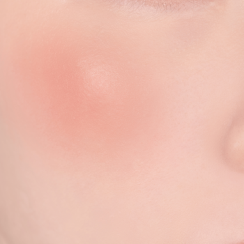 Cera: zbliżenie na jasną skórę policzka z okrągłym, zaczerwienionym, lekko podniesionym wypryskiem.