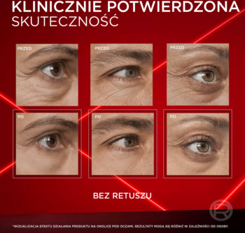 Krem L’Oréal Revitalift Laser. 6 zbliżeń oczu, efekty 'przed i po' redukcji worków i zmarszczek pod oczami.
