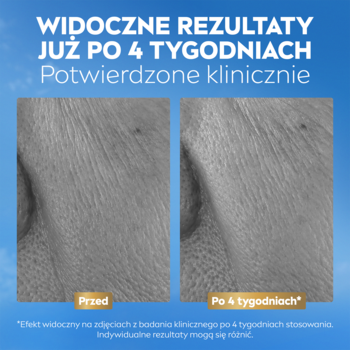 NIVEA Q10 Serum: redukcja głębokich zmarszczek i ujędrnienie skóry w 4 tyg. na zdjęciach przed i po.