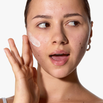 Młoda kobieta nakłada krem-żel na skórę z przebarwieniami potrądzikowymi. Redukuje trądzik i pory.