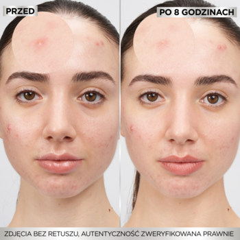 Porównanie twarzy: przed i po użyciu plastrów Garnier Pure Active na trądzik. Zredukowane wypryski po 8h.