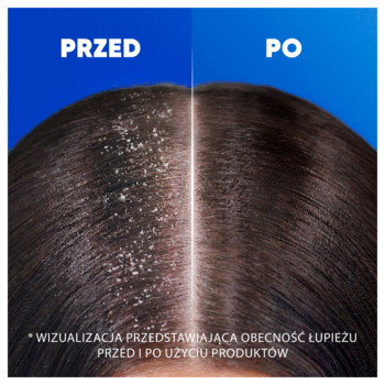 Porównanie skóry głowy przed i po użyciu szamponu Head & Shoulders Menthol Fresh, z łupieżem i bez.